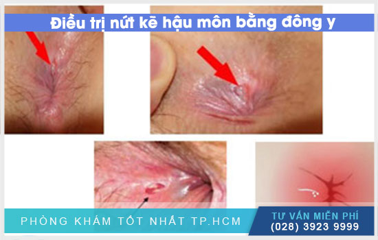 Điều trị nứt kẽ hậu môn